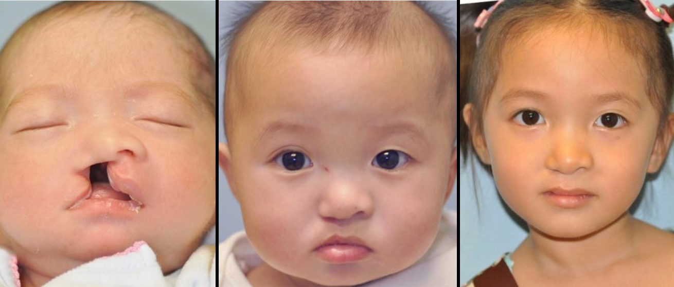 Cleft Lip and Palate